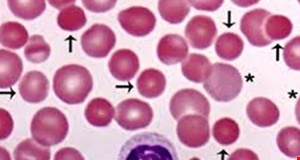 Ứng dụng xét nghiệm tổng phân tích tế bào máu trong định hướng chẩn đoán Thalassemia